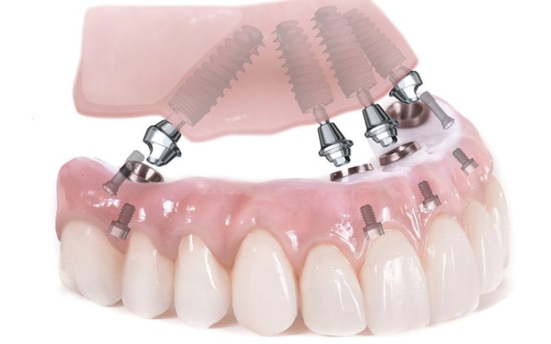 Implantología-Dental-Técnica-All-On-4-Dr-Candau-Maxilofacial-Córdoba