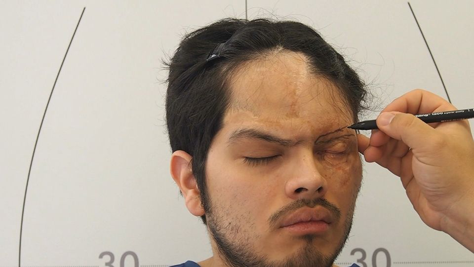 Técnica-FUE-Microinjerto-capilar-Reconstrucción-ceja-dr-candau