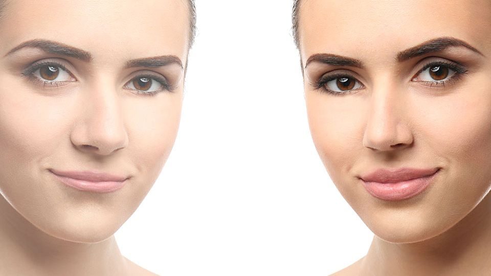 lip-lift-imagen-central