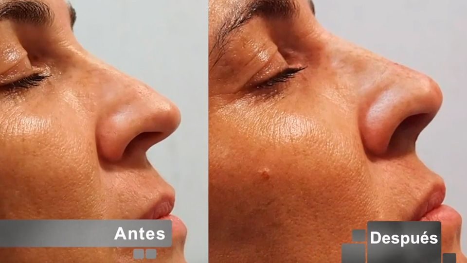 rinomodelación-dr-alberto-candau