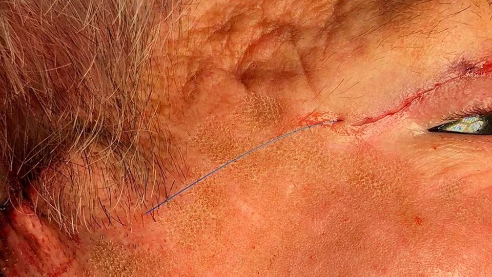 laser-co2-fraccionado-dr-candau