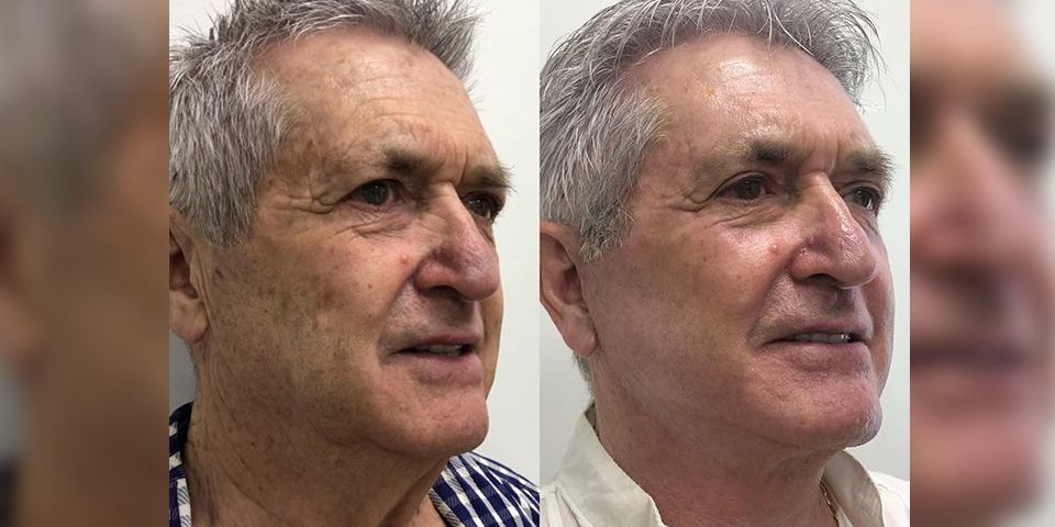 rejuvenecimiento facial