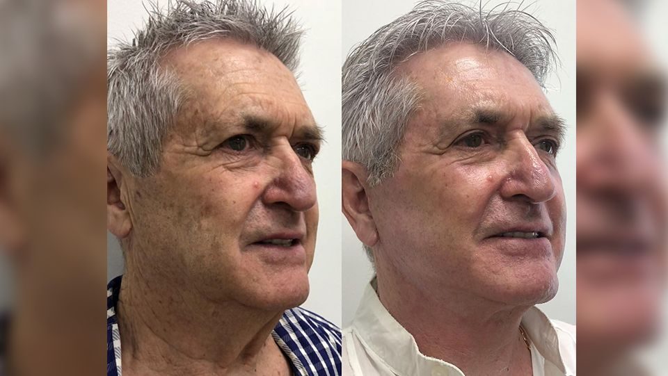 rejuvenecimiento facial