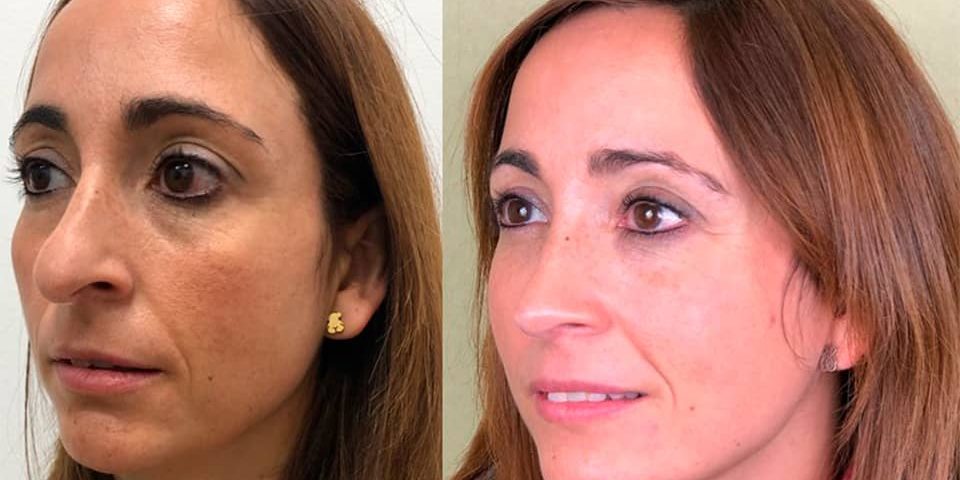 rinoplastia_ultrasonica_ambulatoria_bajo_sedacion_drcandau