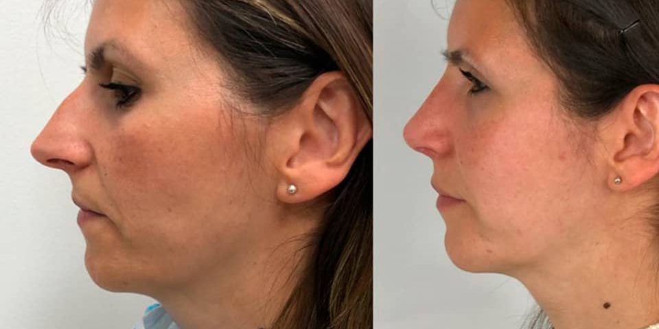 rinoplastia_ultrasonica_ambulatoria_bajo_sedacion_drcandau_d