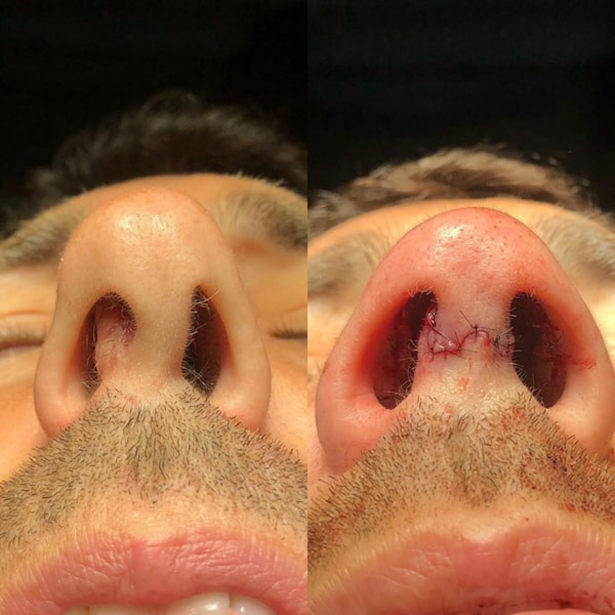 Corrección de deformidad en el tabique nasal