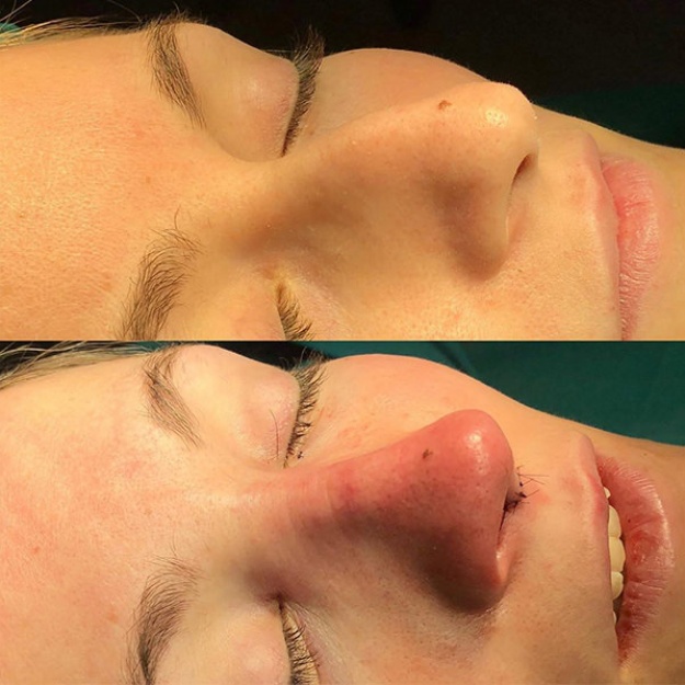 Corregida la giba osteocartilaginosa, desproyección de la punta y modificación del ángulo que forma la nariz con el labio